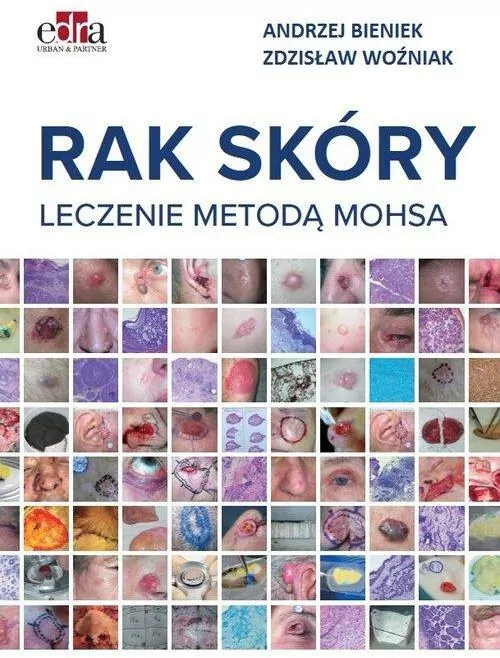 Rak skóry. Leczenie metodą Mohsa - tantis.pl