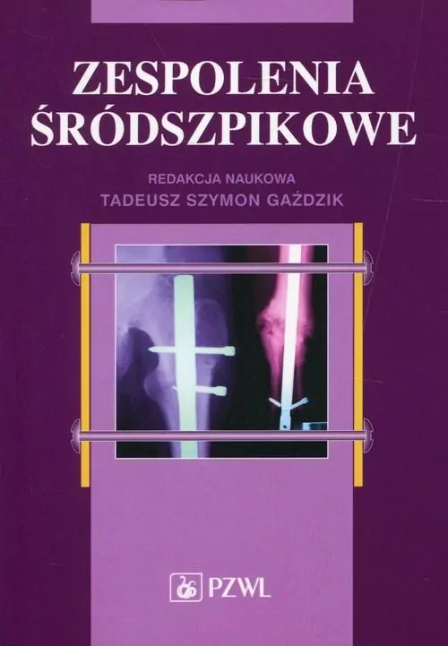 Zespolenia śródszpikowe - tantis.pl