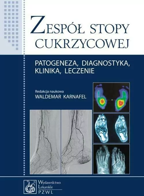 Zespół stopy cukrzycowej. Patogeneza, diagnostyka, klinika, leczenie - tantis.pl