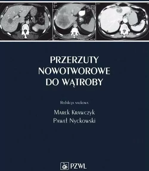 Przerzuty nowotworowe do wątroby - tantis.pl