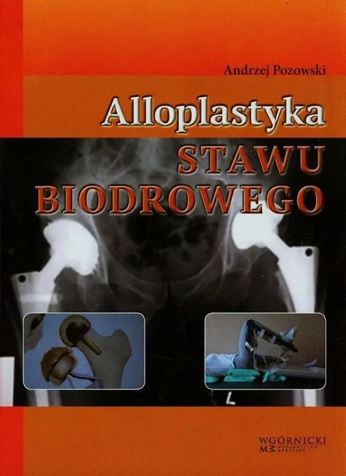 Alloplastyka stawu biodrowego - tantis.pl