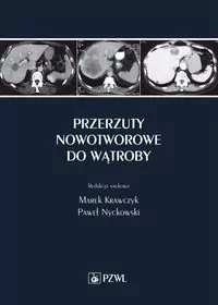 Przerzuty nowotworowe do wątroby - tantis.pl